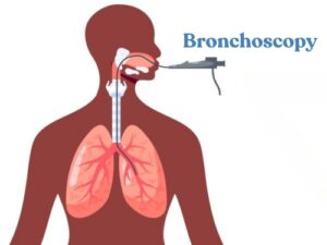 RSDC | Understanding Bronchoscopy Procedures